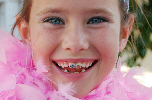 Colored Braces